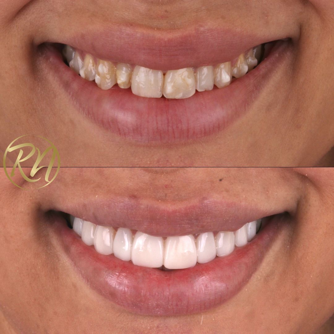 Resultado 1 - Facetas