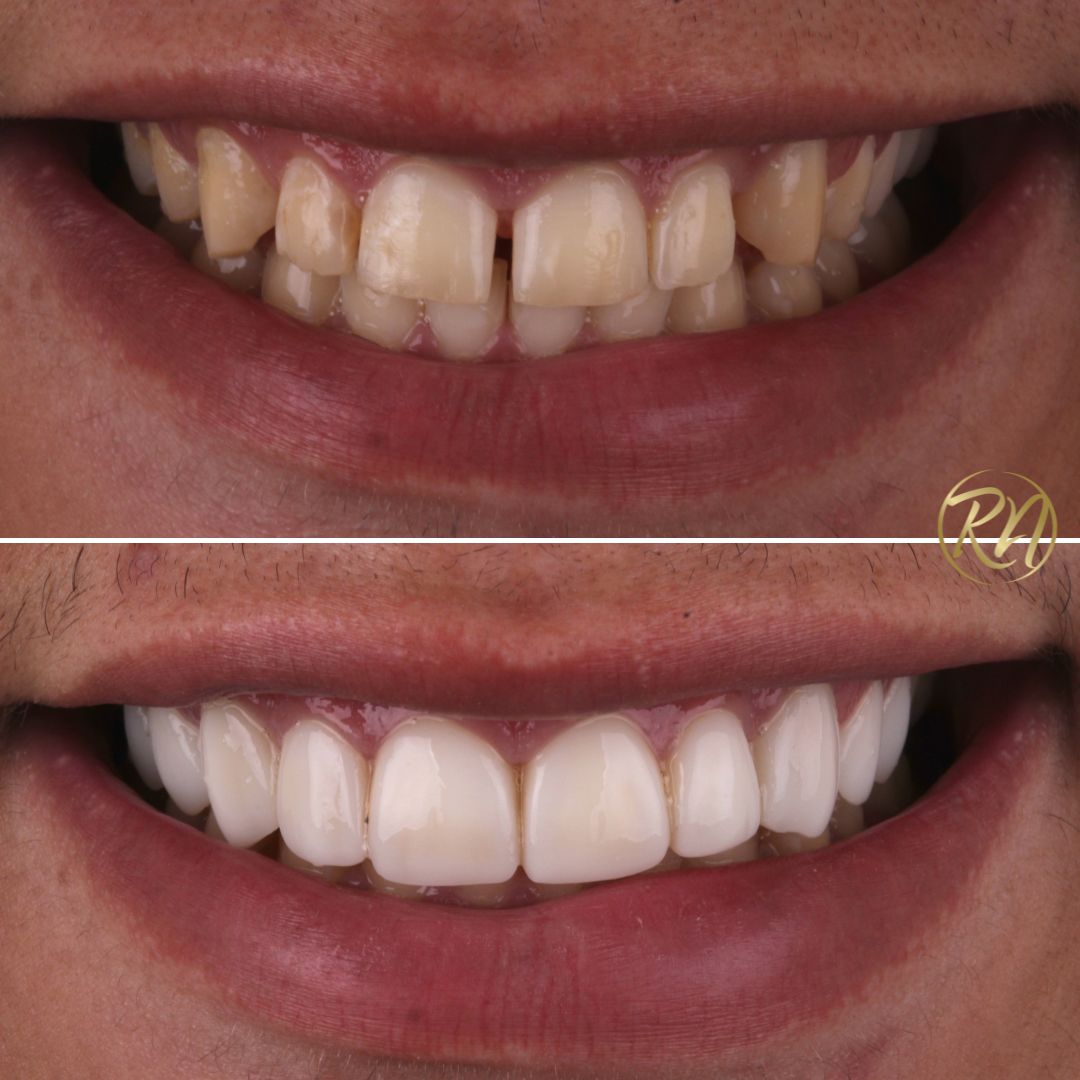 Resultado 2 - Facetas